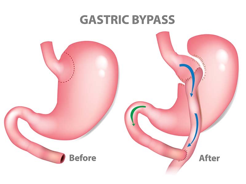 https://clinoraclinic.ghayatltd.com/wp-content/uploads/2026/06/materials/gastric- bypass/stock-vector-gastric-bypass-surgery-rny-roux-en-y-mini-gastric-bypass-1136825978.jpg